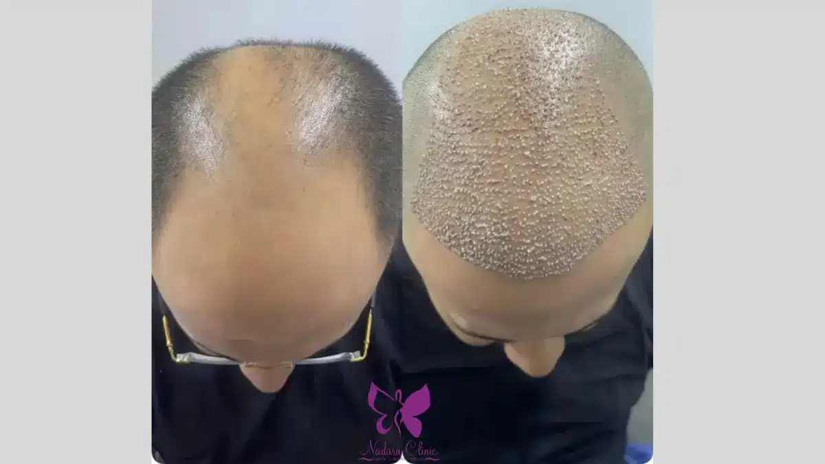 زراعة الشعر في الغردقة